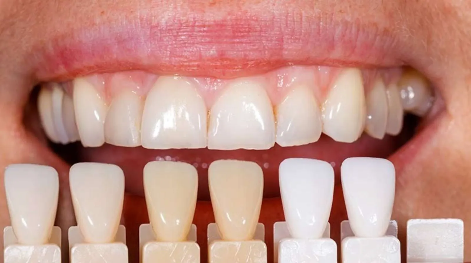 Comparación de tono dental con guía de color para estética dental, Clínica Dental Rita Otero
