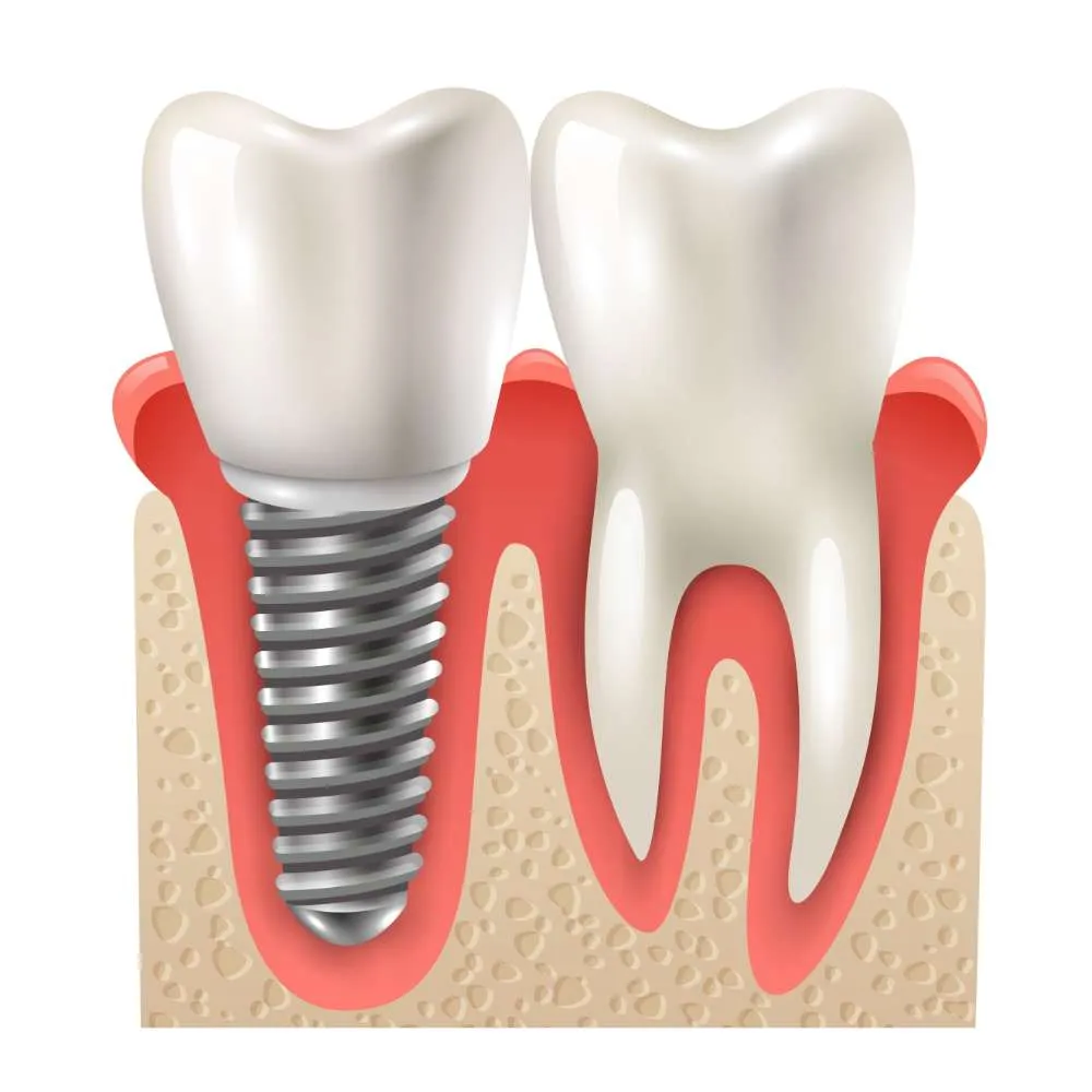 Ilustración de un implante dental de titanio junto a un diente natural, Clínica Dental Rita Otero