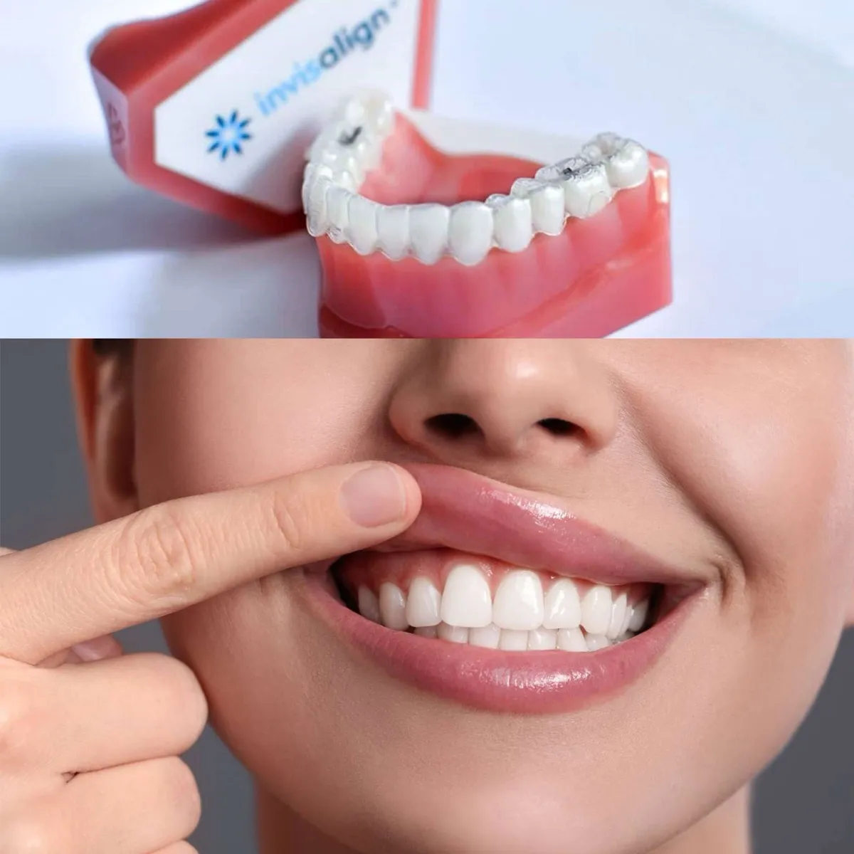 Alineador transparente de ortodoncia junto a una sonrisa, en la Clínica Dental Rita Otero