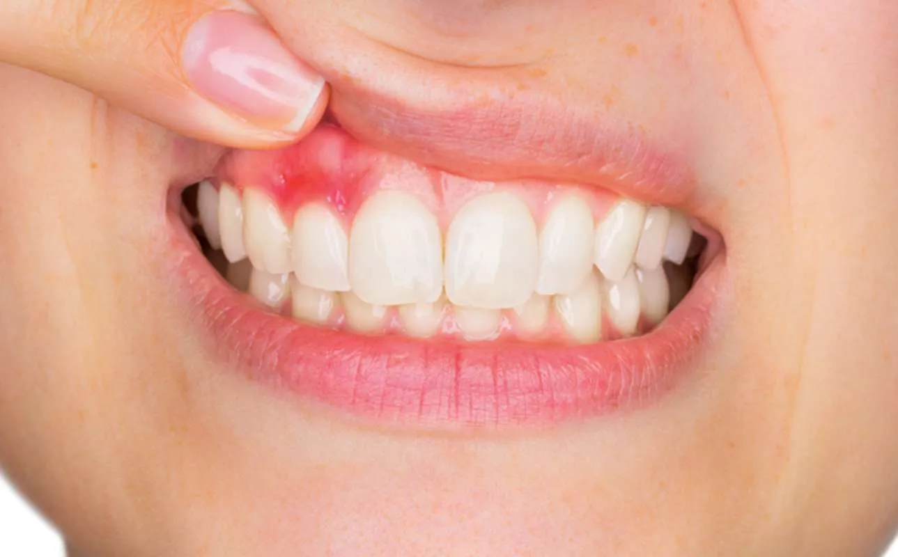 Encía inflamada en una sonrisa, tratamiento de periodoncia en la Clínica Dental Rita Otero