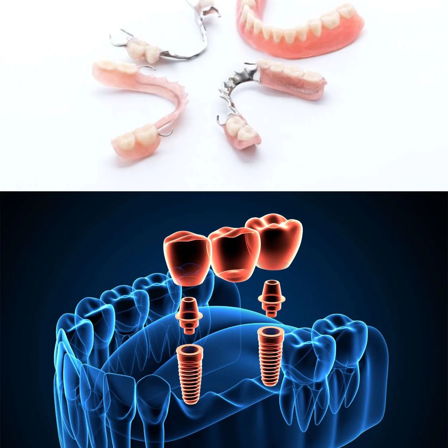 Prótesis dentales removibles sobre fondo blanco, rehabilitación en la Clínica Dental Rita Otero